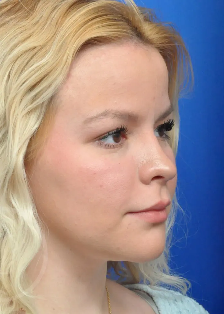 Plastic Surgery Before and After Pictures in Jacksonville, FL - Garcia Facial Plastic Surgery