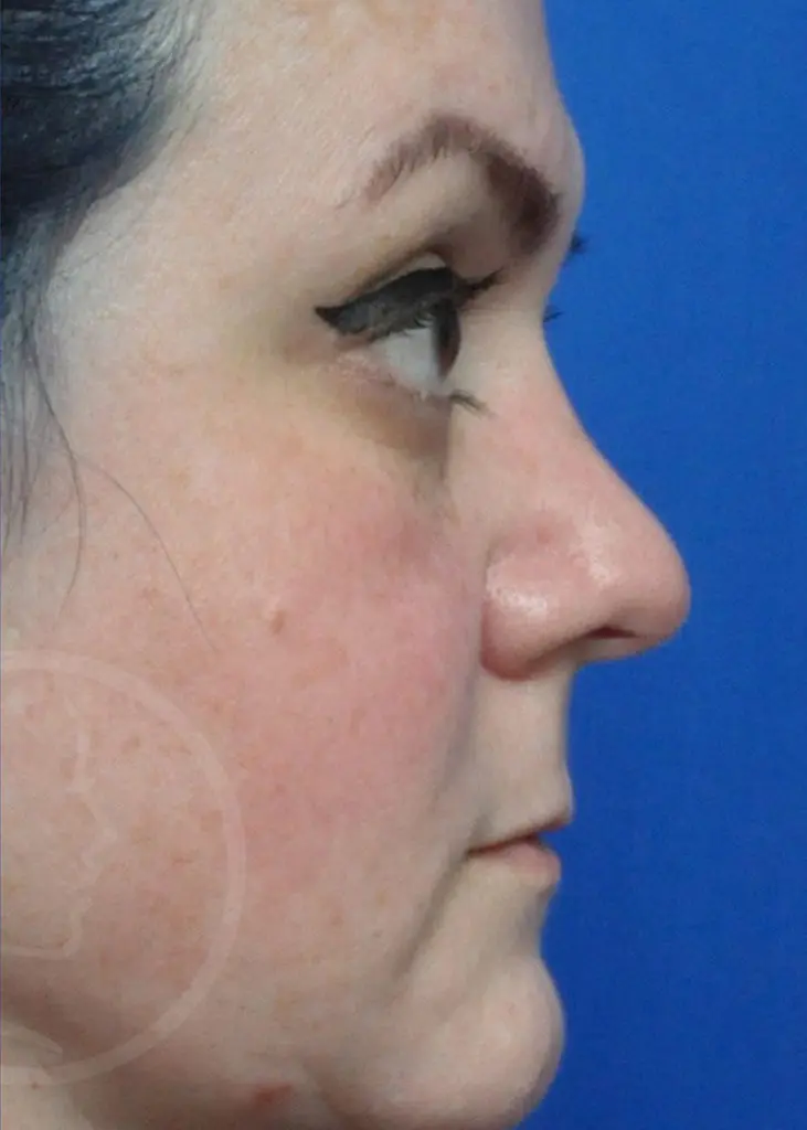 Plastic Surgery Before and After Pictures in Jacksonville, FL - Garcia Facial Plastic Surgery