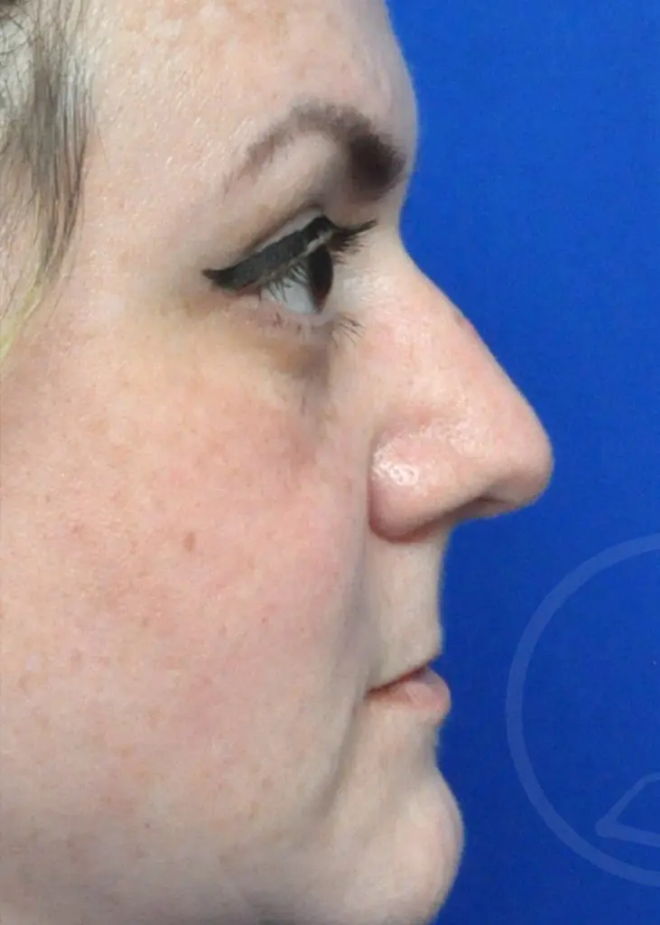 Plastic Surgery Before and After Pictures in Jacksonville, FL - Garcia Facial Plastic Surgery