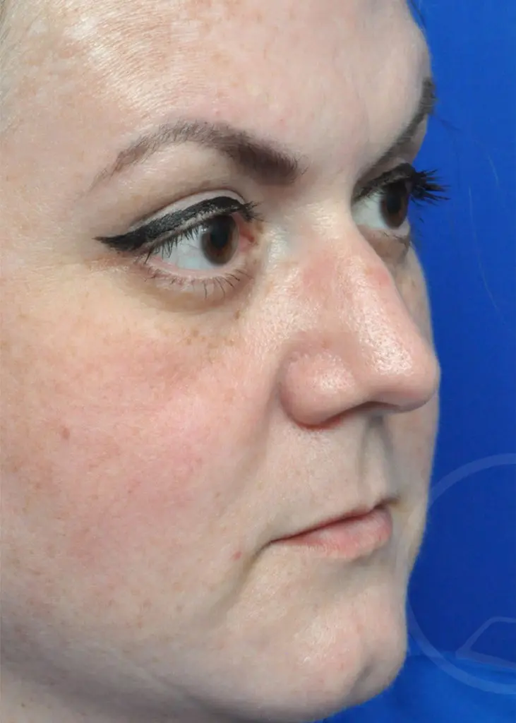 Plastic Surgery Before and After Pictures in Jacksonville, FL - Garcia Facial Plastic Surgery