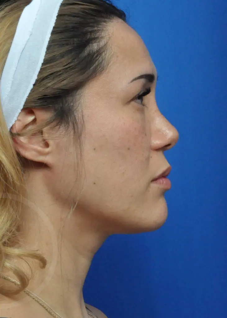 Plastic Surgery Before and After Pictures in Jacksonville, FL - Garcia Facial Plastic Surgery