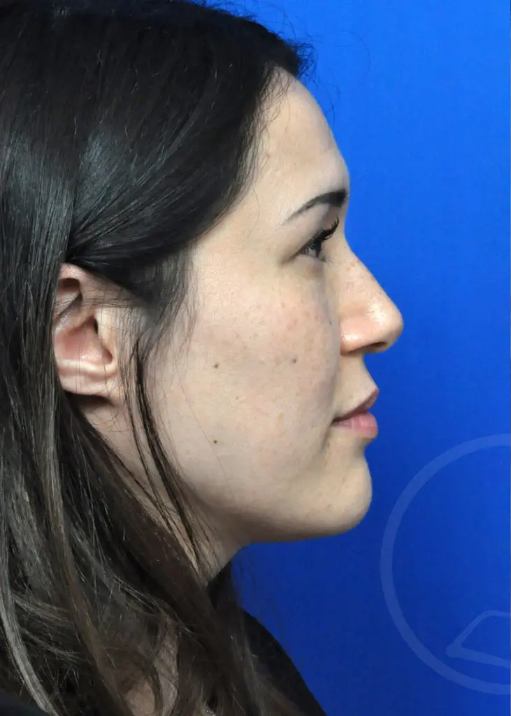 Plastic Surgery Before and After Pictures in Jacksonville, FL - Garcia Facial Plastic Surgery