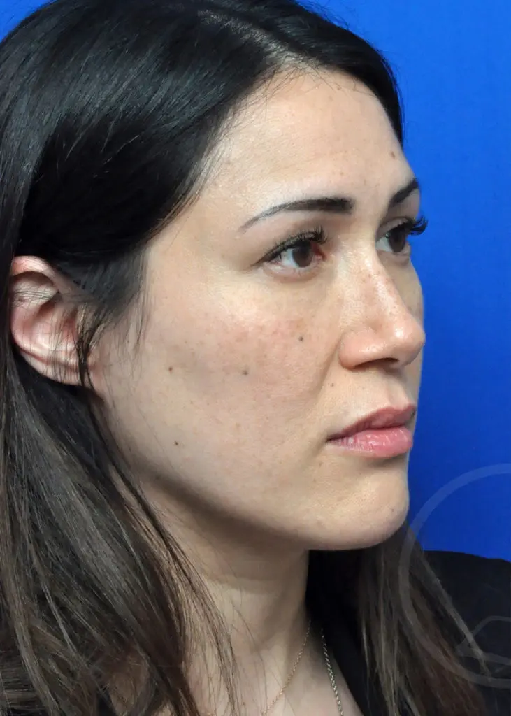 Plastic Surgery Before and After Pictures in Jacksonville, FL - Garcia Facial Plastic Surgery