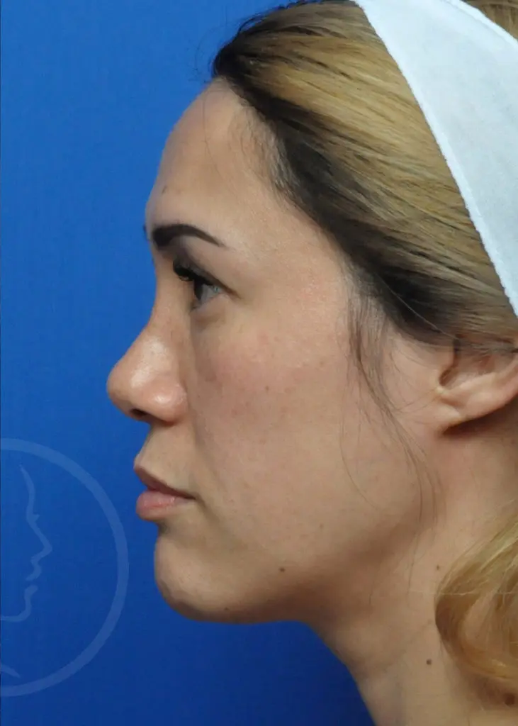 Plastic Surgery Before and After Pictures in Jacksonville, FL - Garcia Facial Plastic Surgery