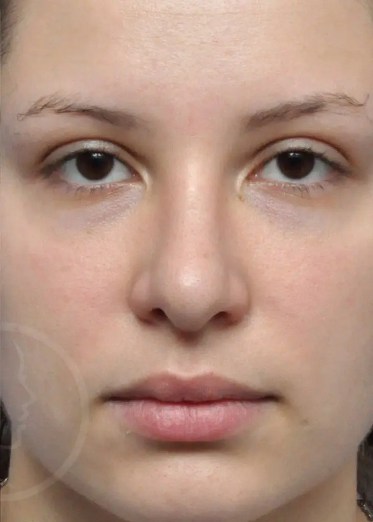 Plastic Surgery Before and After Pictures in Jacksonville, FL - Garcia Facial Plastic Surgery