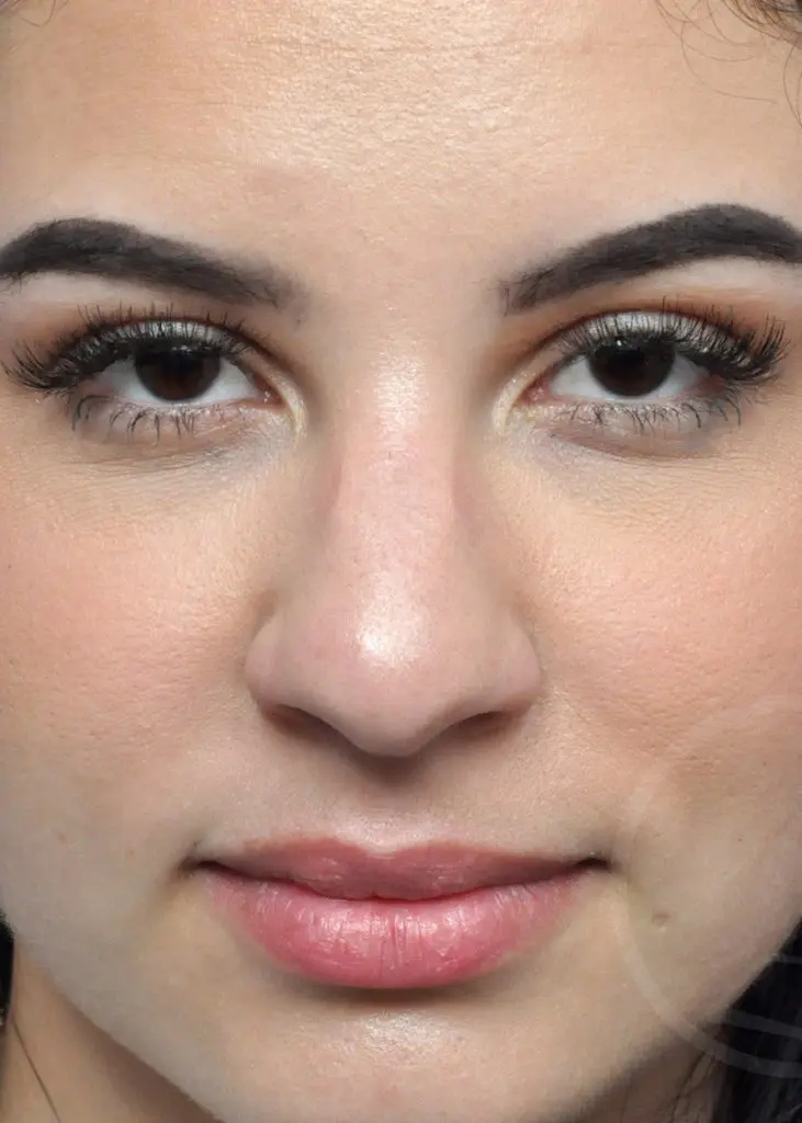 Plastic Surgery Before and After Pictures in Jacksonville, FL - Garcia Facial Plastic Surgery