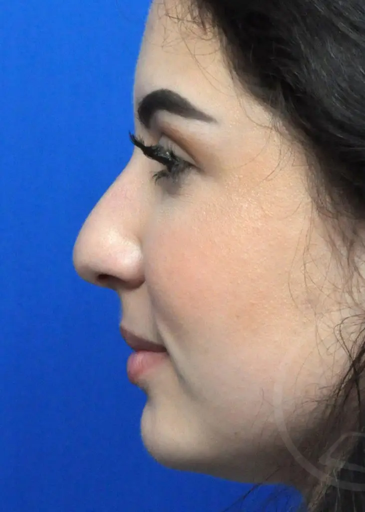 Plastic Surgery Before and After Pictures in Jacksonville, FL - Garcia Facial Plastic Surgery