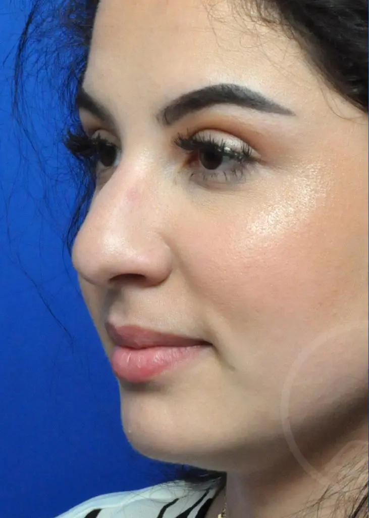 Plastic Surgery Before and After Pictures in Jacksonville, FL - Garcia Facial Plastic Surgery