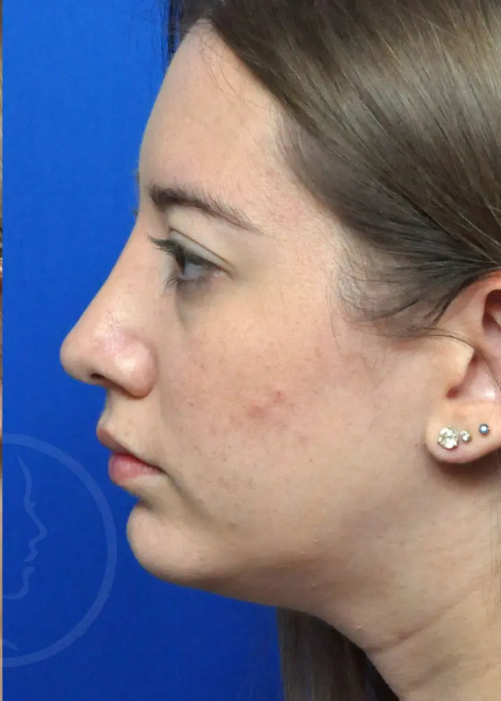 Plastic Surgery Before and After Pictures in Jacksonville, FL - Garcia Facial Plastic Surgery