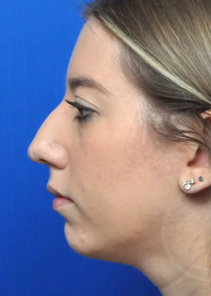 Plastic Surgery Before and After Pictures in Jacksonville, FL - Garcia Facial Plastic Surgery