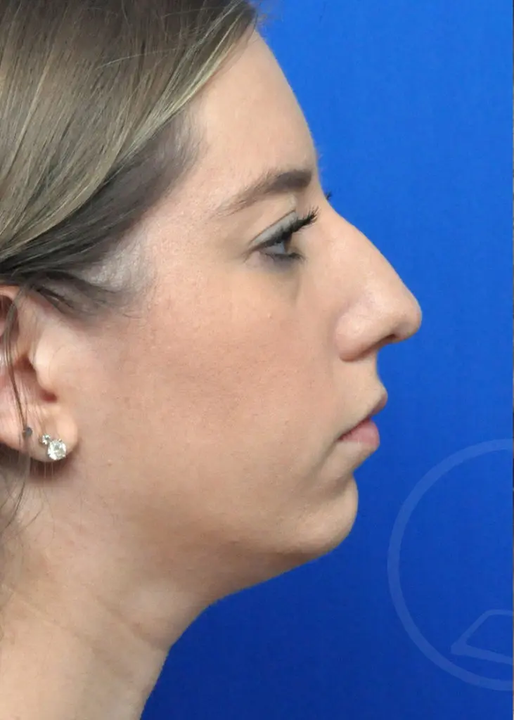 Plastic Surgery Before and After Pictures in Jacksonville, FL - Garcia Facial Plastic Surgery
