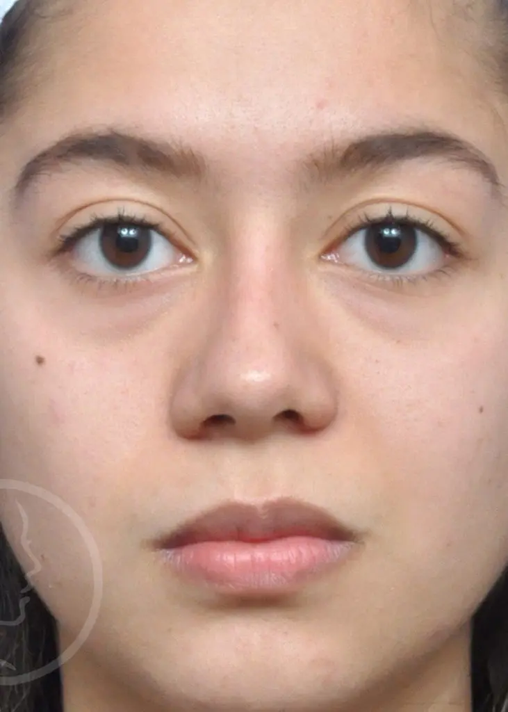 Plastic Surgery Before and After Pictures in Jacksonville, FL - Garcia Facial Plastic Surgery