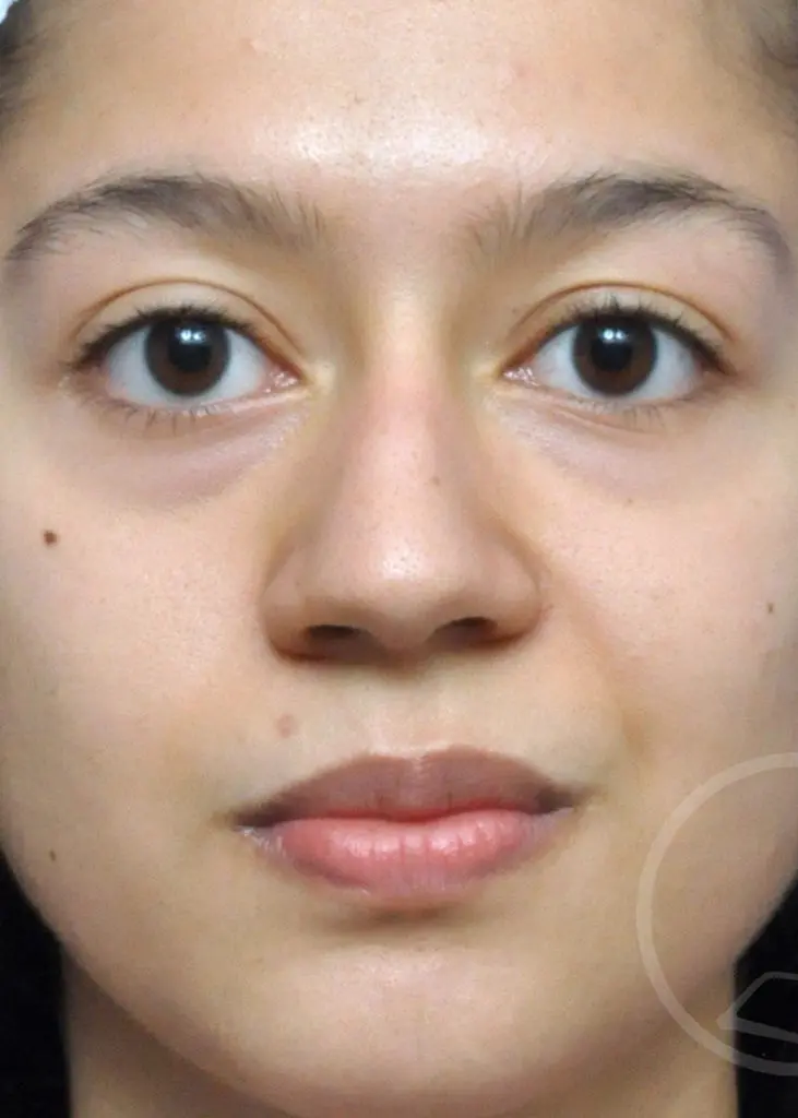 Plastic Surgery Before and After Pictures in Jacksonville, FL - Garcia Facial Plastic Surgery