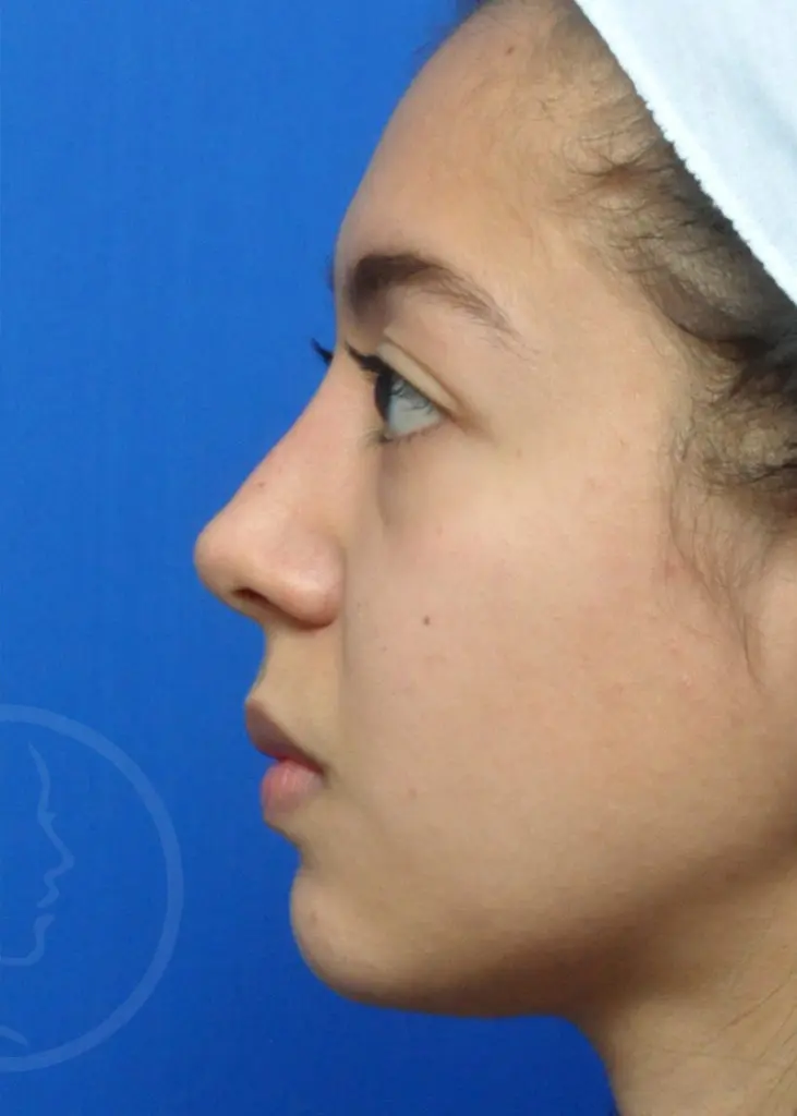 Plastic Surgery Before and After Pictures in Jacksonville, FL - Garcia Facial Plastic Surgery