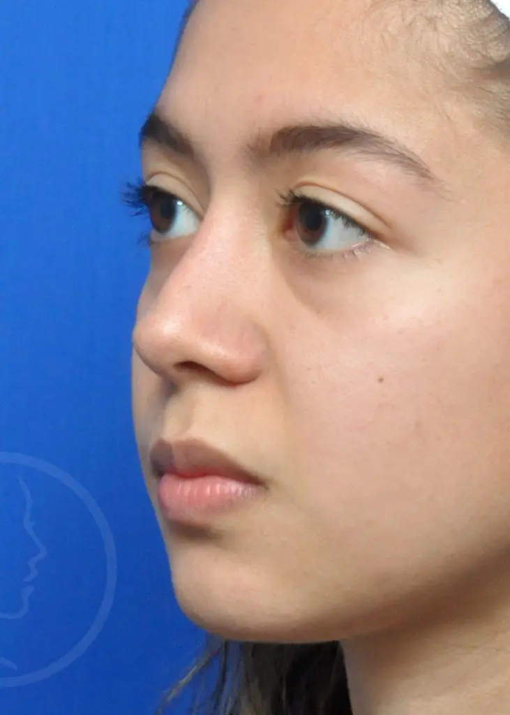 Plastic Surgery Before and After Pictures in Jacksonville, FL - Garcia Facial Plastic Surgery