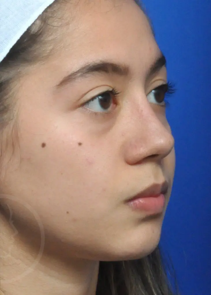Plastic Surgery Before and After Pictures in Jacksonville, FL - Garcia Facial Plastic Surgery
