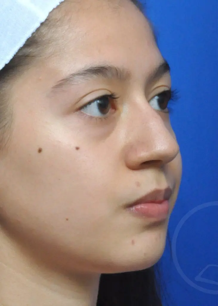 Plastic Surgery Before and After Pictures in Jacksonville, FL - Garcia Facial Plastic Surgery