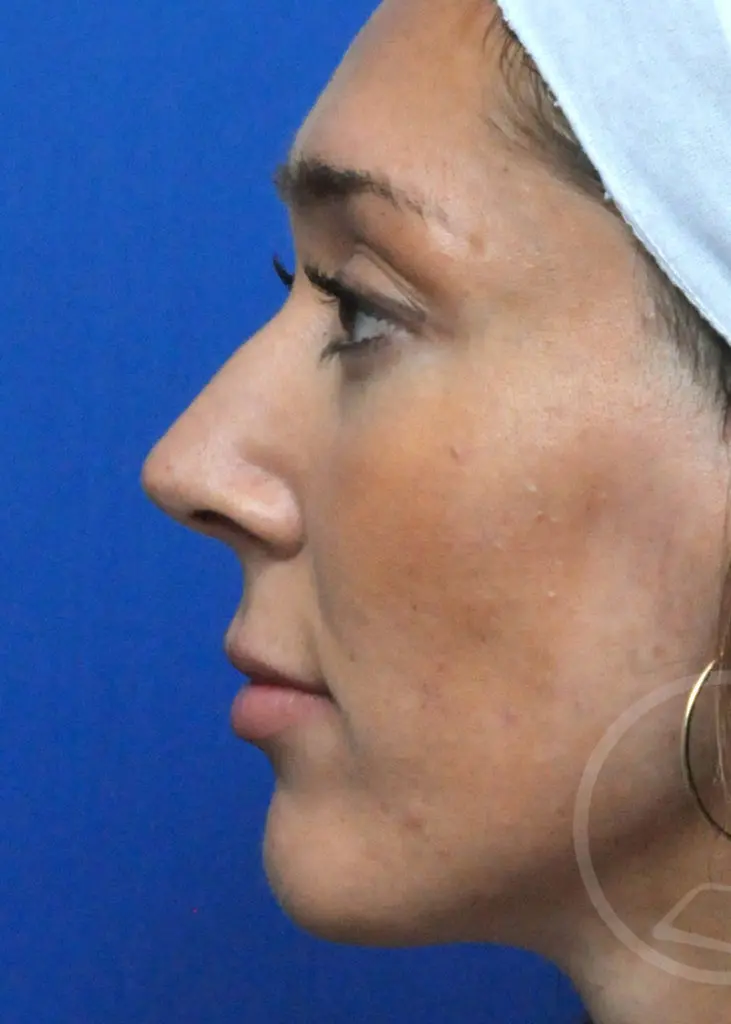 Plastic Surgery Before and After Pictures in Jacksonville, FL - Garcia Facial Plastic Surgery