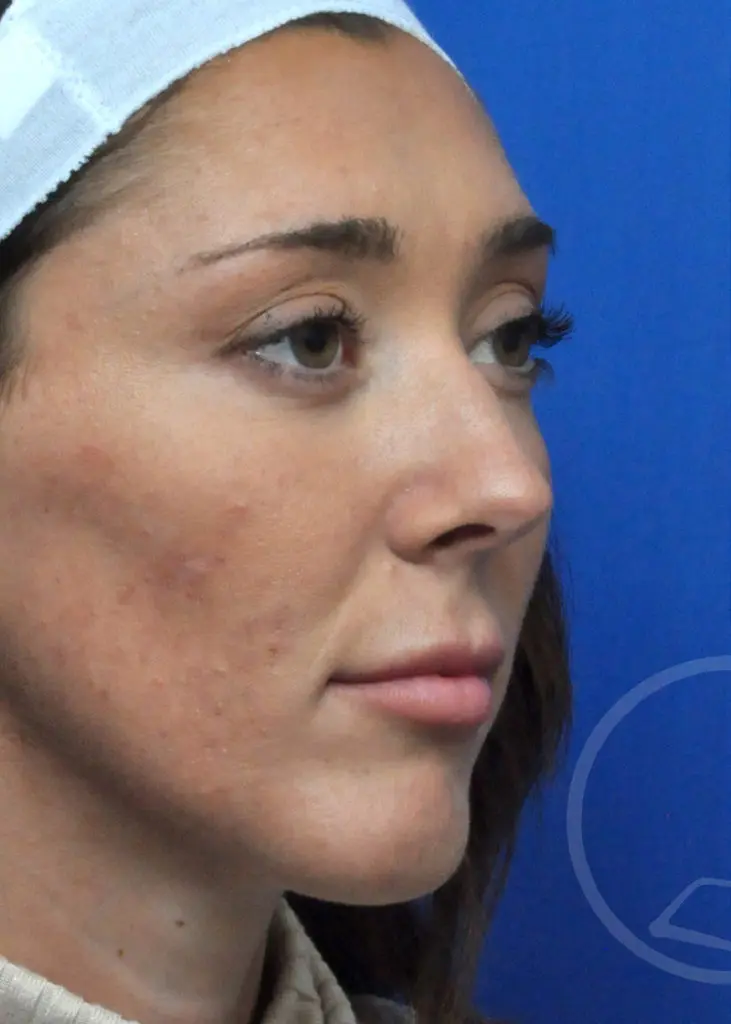 Plastic Surgery Before and After Pictures in Jacksonville, FL - Garcia Facial Plastic Surgery