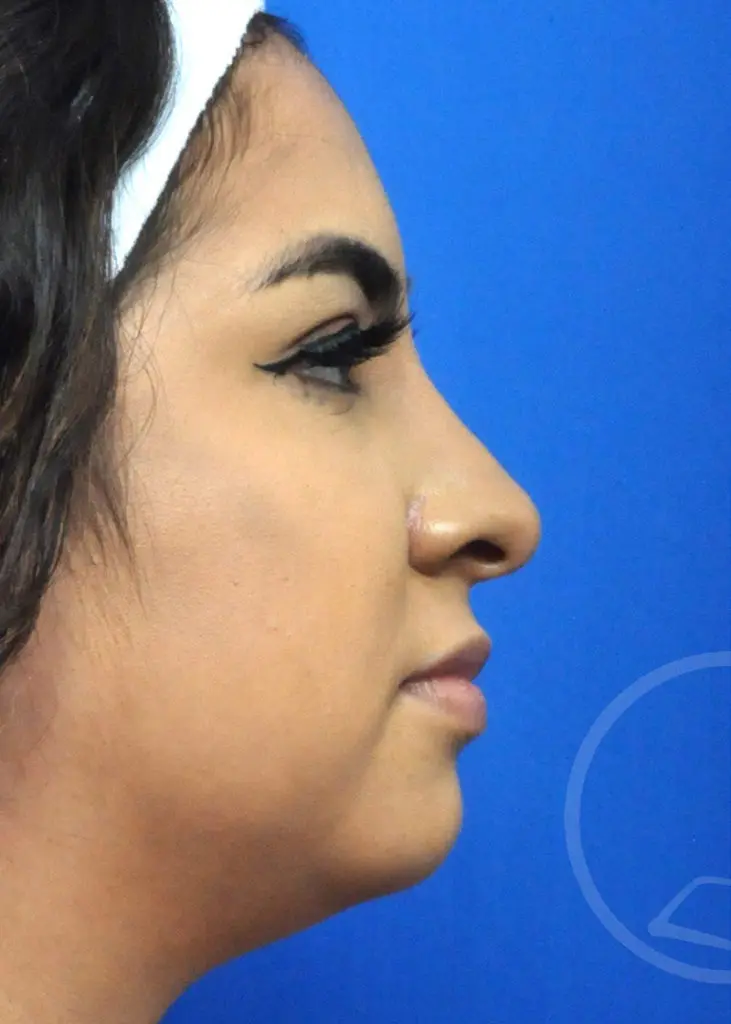 Plastic Surgery Before and After Pictures in Jacksonville, FL - Garcia Facial Plastic Surgery