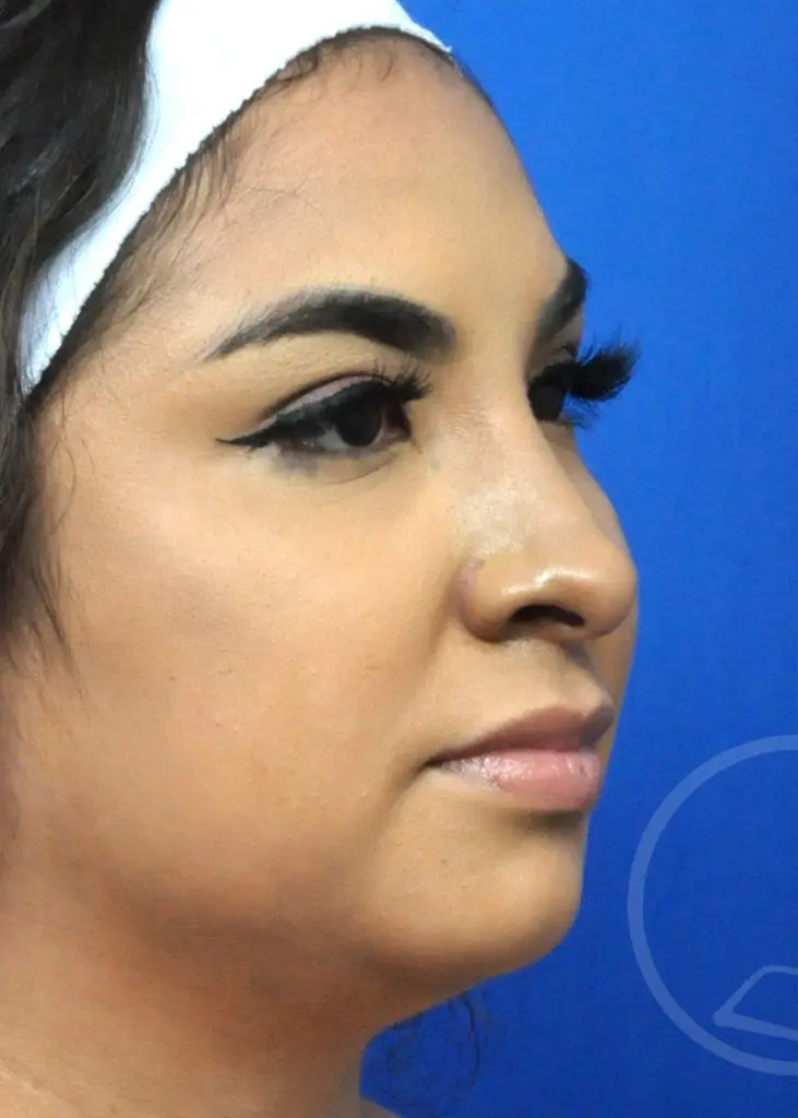Plastic Surgery Before and After Pictures in Jacksonville, FL - Garcia Facial Plastic Surgery