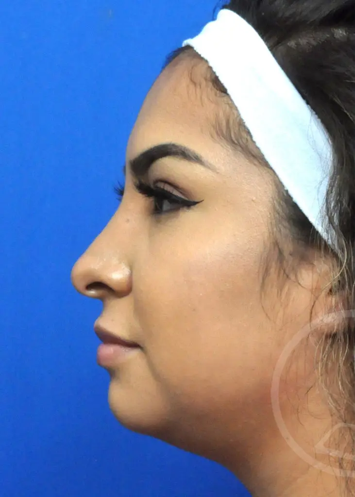 Plastic Surgery Before and After Pictures in Jacksonville, FL - Garcia Facial Plastic Surgery