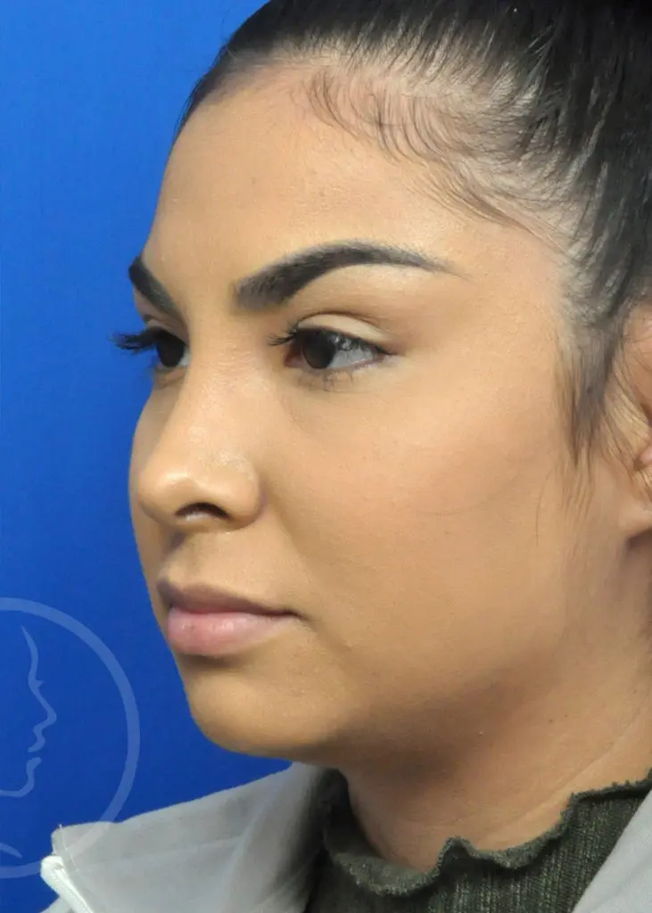 Plastic Surgery Before and After Pictures in Jacksonville, FL - Garcia Facial Plastic Surgery