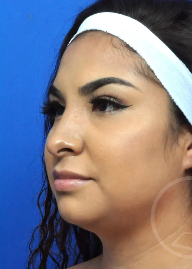 Plastic Surgery Before and After Pictures in Jacksonville, FL - Garcia Facial Plastic Surgery