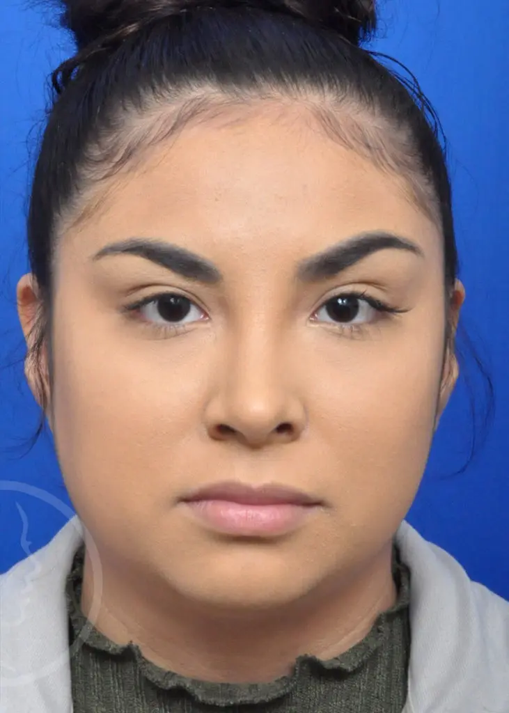 Plastic Surgery Before and After Pictures in Jacksonville, FL - Garcia Facial Plastic Surgery