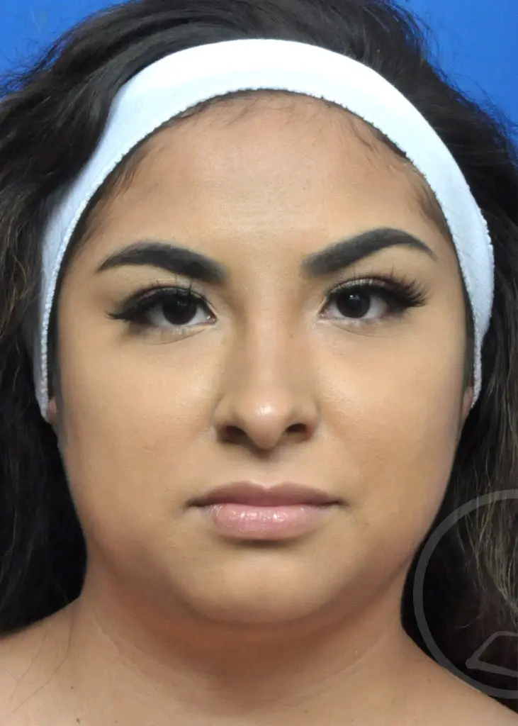 Plastic Surgery Before and After Pictures in Jacksonville, FL - Garcia Facial Plastic Surgery