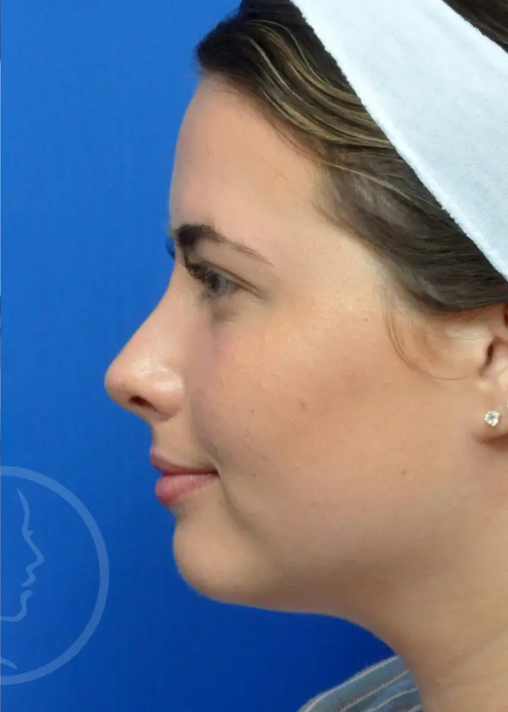 Plastic Surgery Before and After Pictures in Jacksonville, FL - Garcia Facial Plastic Surgery
