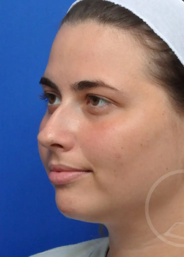 Plastic Surgery Before and After Pictures in Jacksonville, FL - Garcia Facial Plastic Surgery