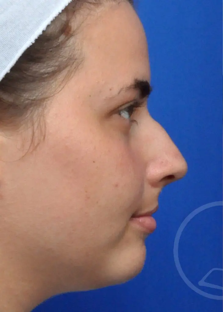 Plastic Surgery Before and After Pictures in Jacksonville, FL - Garcia Facial Plastic Surgery