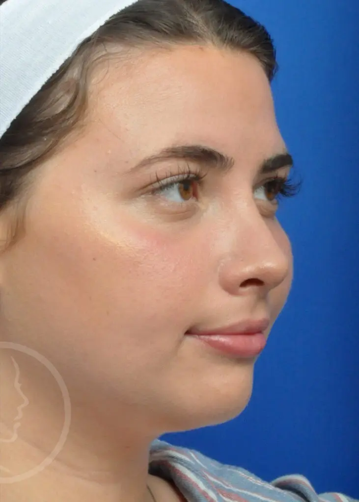 Plastic Surgery Before and After Pictures in Jacksonville, FL - Garcia Facial Plastic Surgery