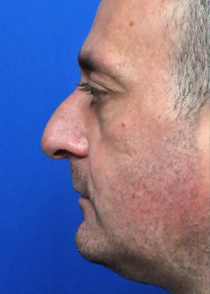 Plastic Surgery Before and After Pictures in Jacksonville, FL - Garcia Facial Plastic Surgery