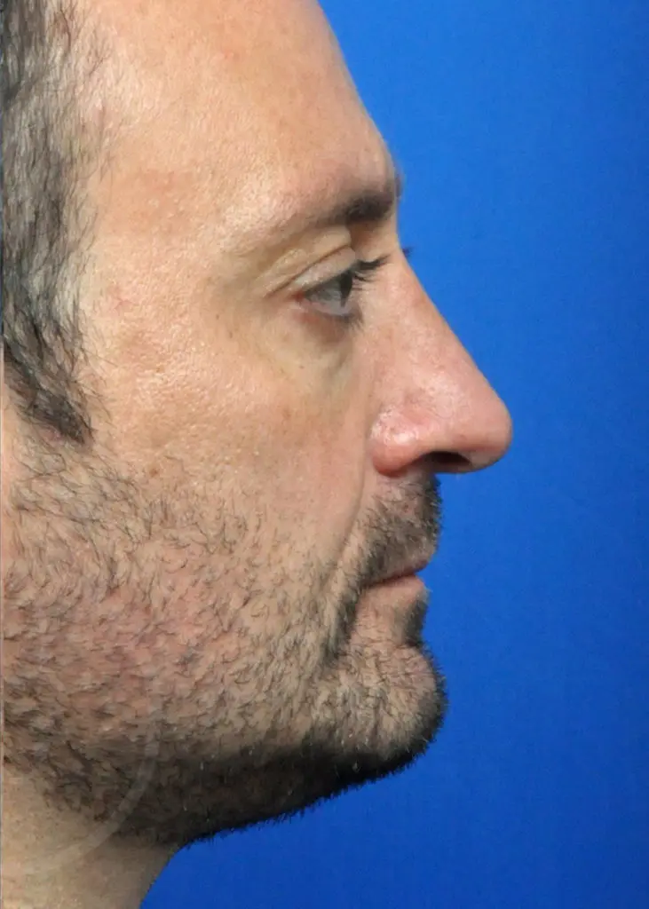 Plastic Surgery Before and After Pictures in Jacksonville, FL - Garcia Facial Plastic Surgery