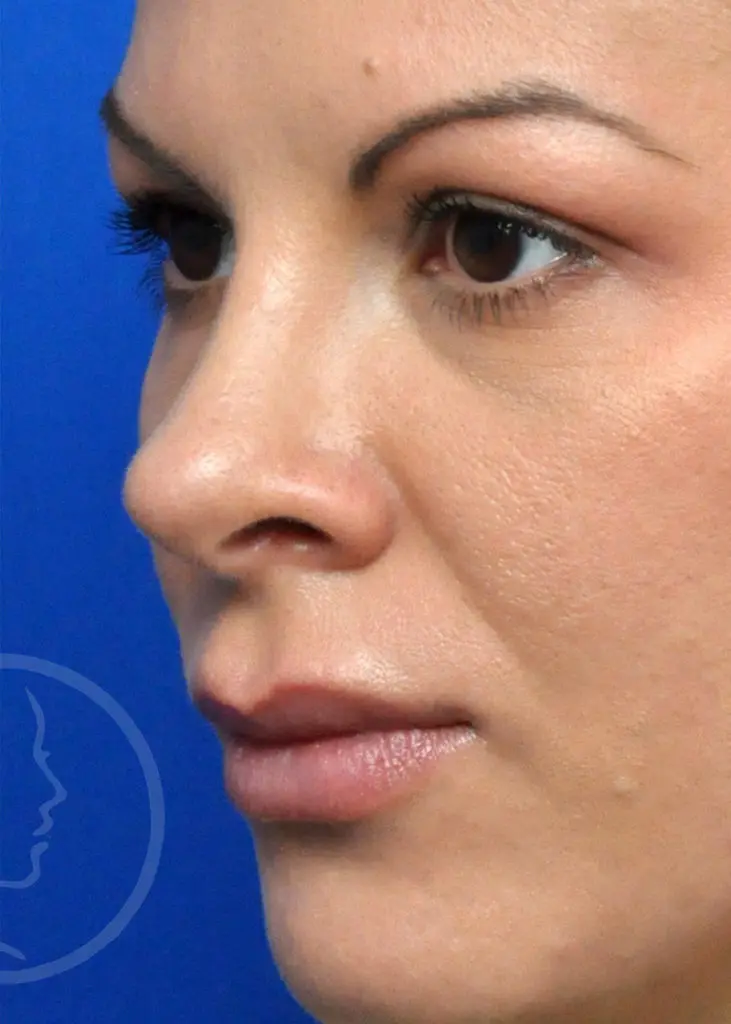 Plastic Surgery Before and After Pictures in Jacksonville, FL - Garcia Facial Plastic Surgery