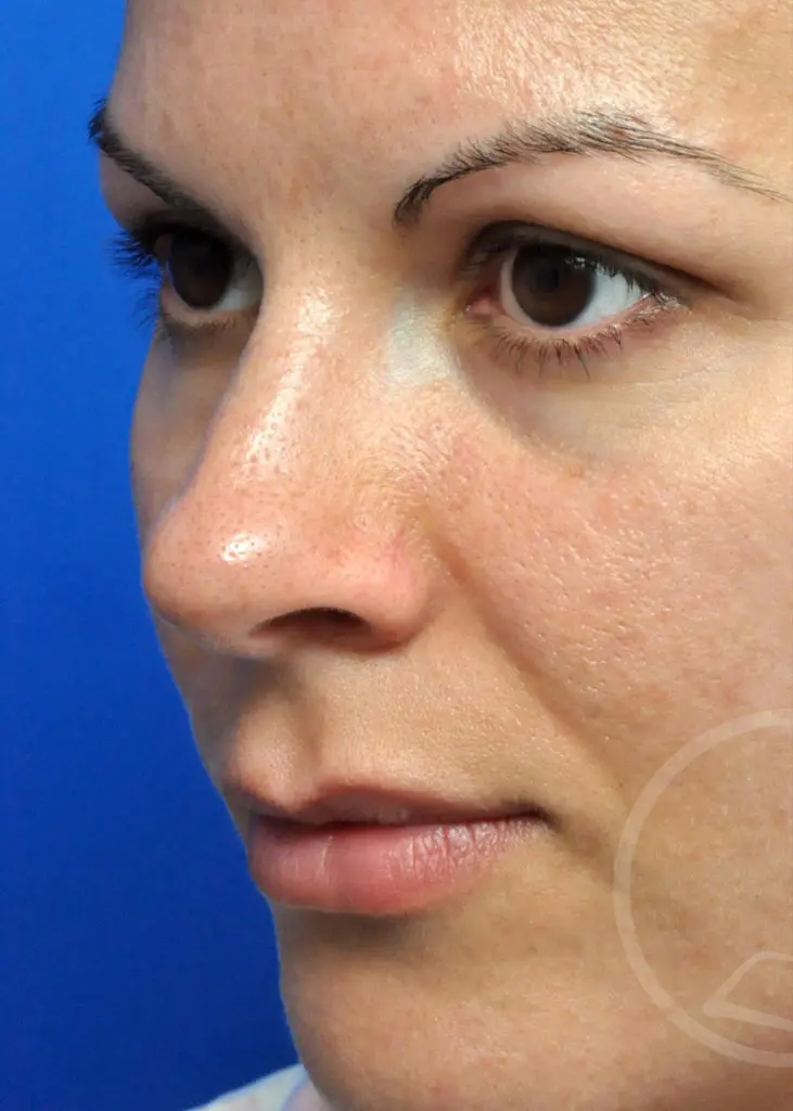 Plastic Surgery Before and After Pictures in Jacksonville, FL - Garcia Facial Plastic Surgery