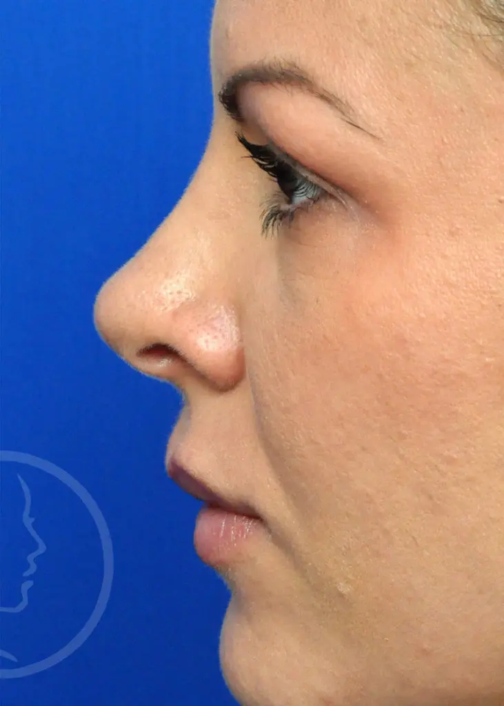 Plastic Surgery Before and After Pictures in Jacksonville, FL - Garcia Facial Plastic Surgery