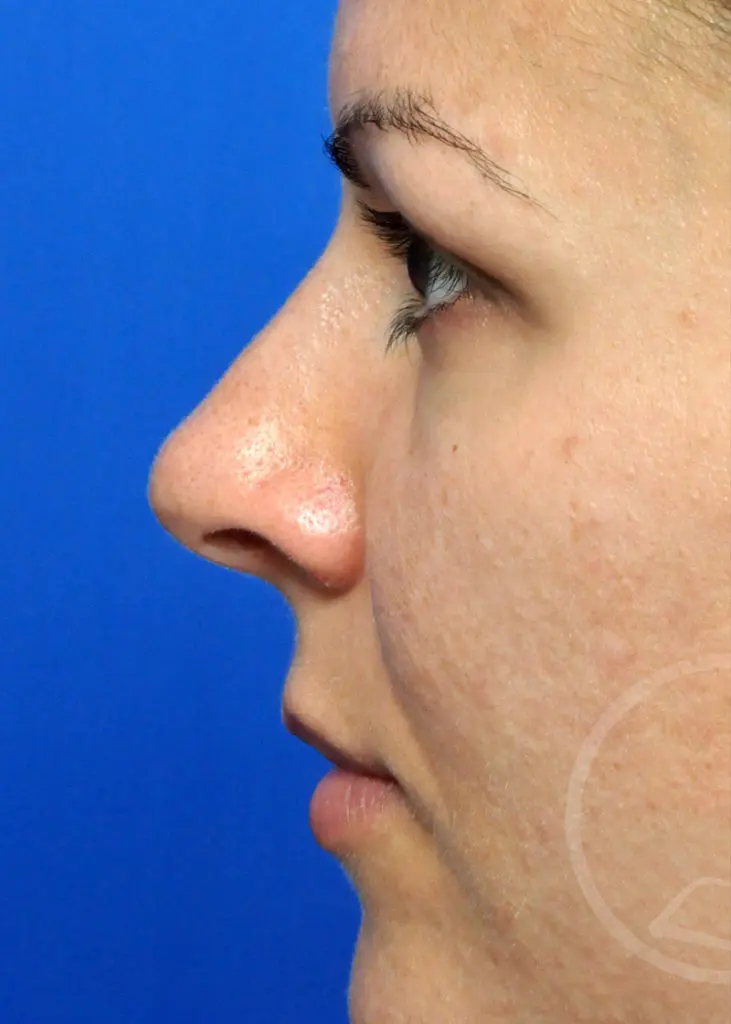 Plastic Surgery Before and After Pictures in Jacksonville, FL - Garcia Facial Plastic Surgery