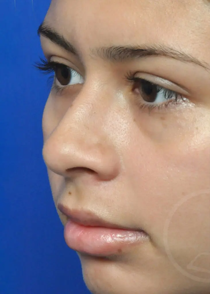 Plastic Surgery Before and After Pictures in Jacksonville, FL - Garcia Facial Plastic Surgery