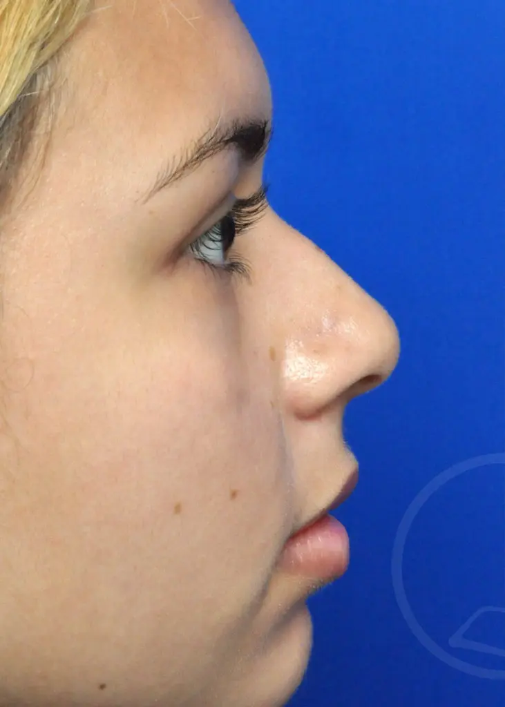 Plastic Surgery Before and After Pictures in Jacksonville, FL - Garcia Facial Plastic Surgery