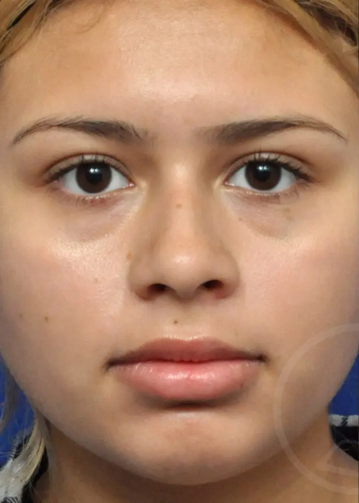 Plastic Surgery Before and After Pictures in Jacksonville, FL - Garcia Facial Plastic Surgery