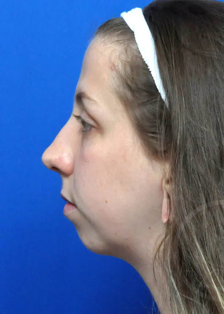 Plastic Surgery Before and After Pictures in Jacksonville, FL - Garcia Facial Plastic Surgery