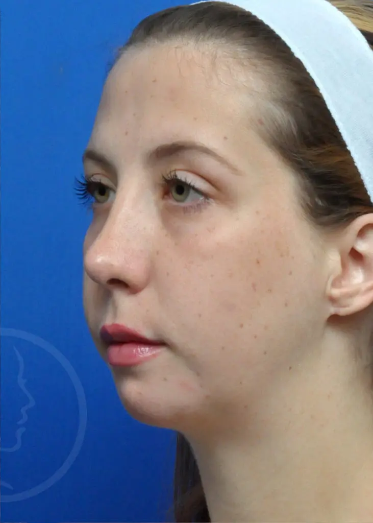 Plastic Surgery Before and After Pictures in Jacksonville, FL - Garcia Facial Plastic Surgery