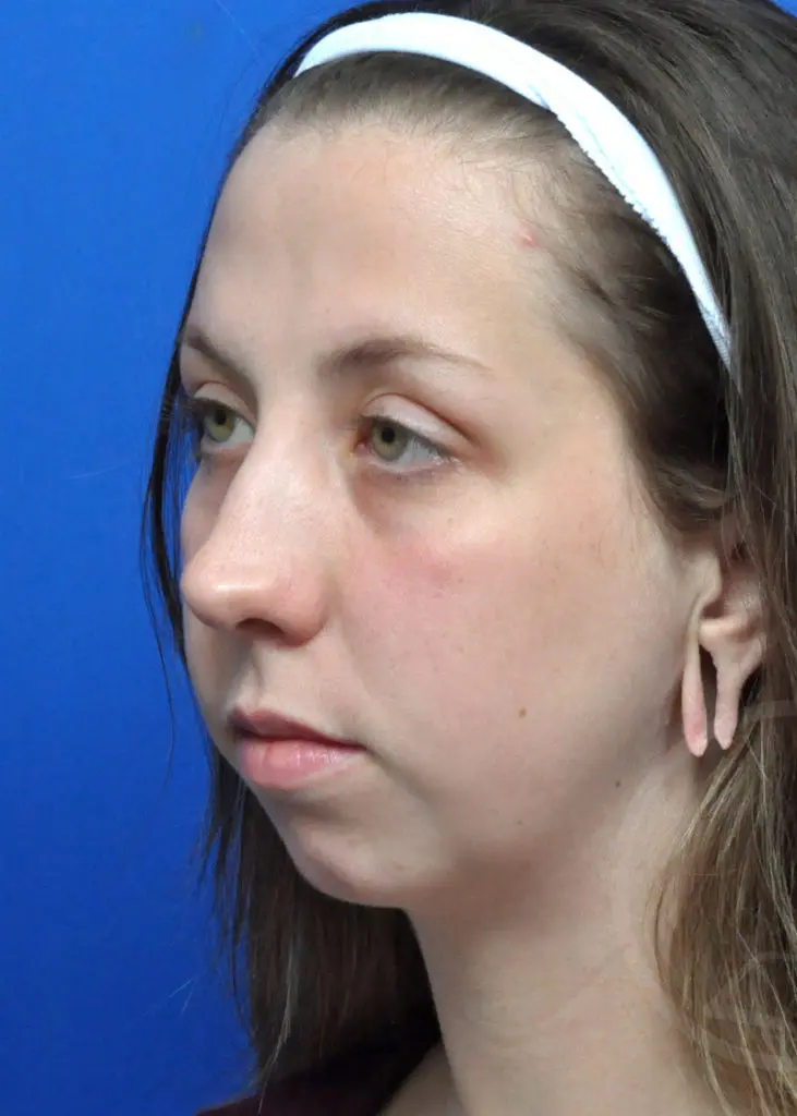 Plastic Surgery Before and After Pictures in Jacksonville, FL - Garcia Facial Plastic Surgery