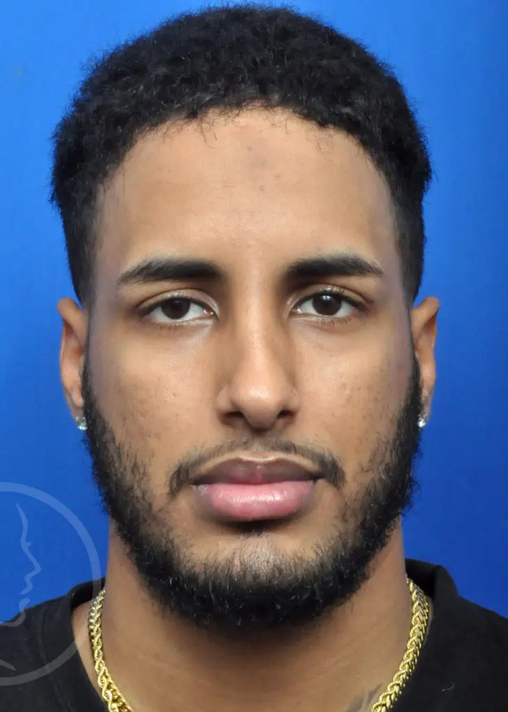 Plastic Surgery Before and After Pictures in Jacksonville, FL - Garcia Facial Plastic Surgery