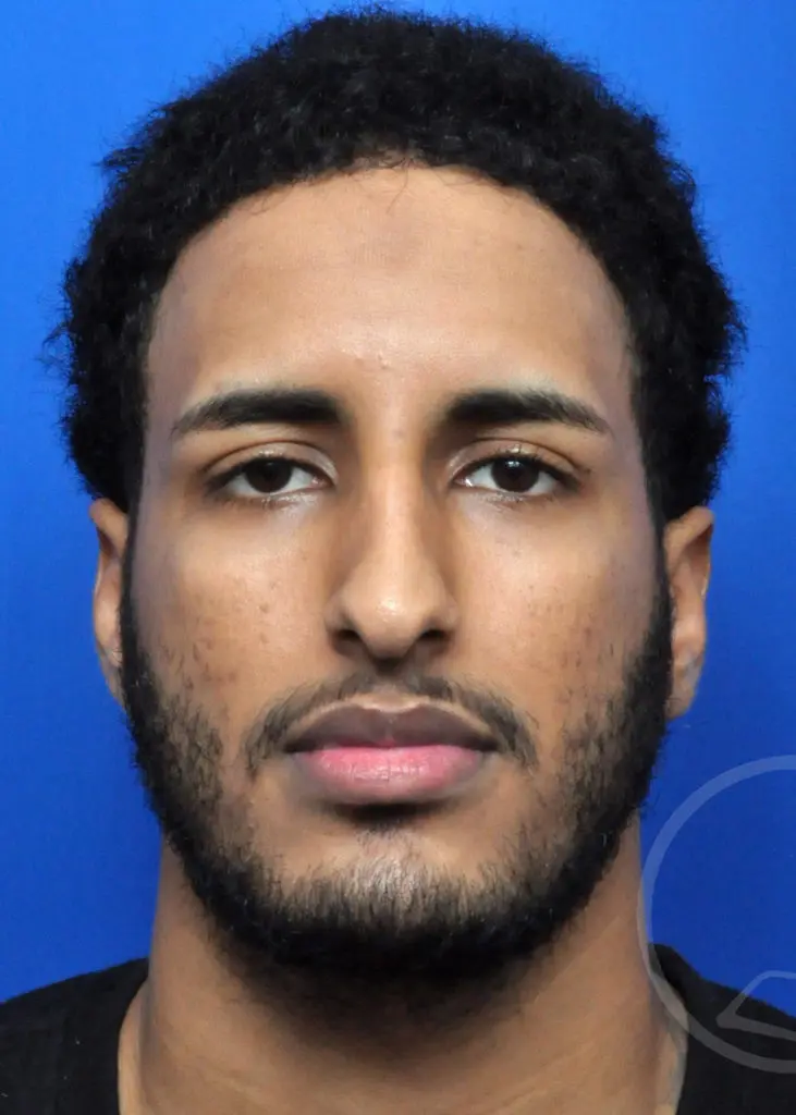 Plastic Surgery Before and After Pictures in Jacksonville, FL - Garcia Facial Plastic Surgery