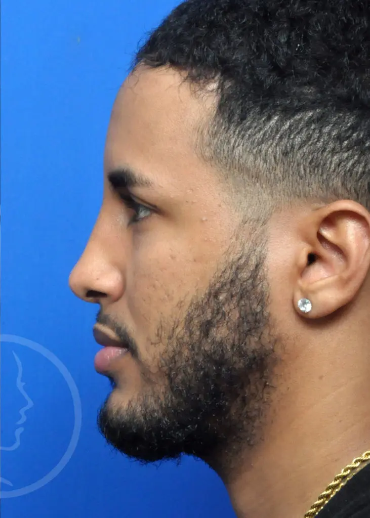 Plastic Surgery Before and After Pictures in Jacksonville, FL - Garcia Facial Plastic Surgery