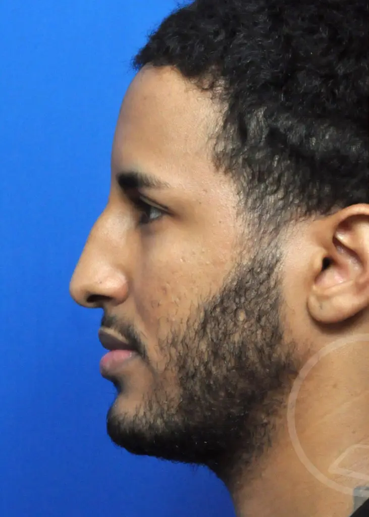 Plastic Surgery Before and After Pictures in Jacksonville, FL - Garcia Facial Plastic Surgery